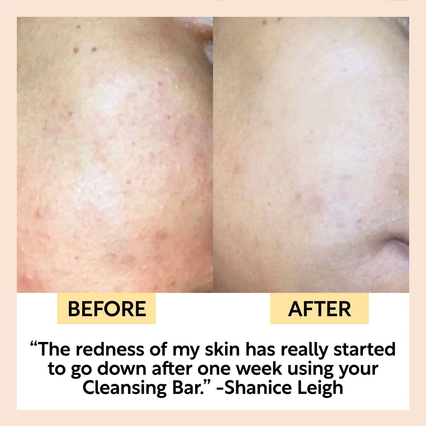 Before and after comparison of skin redness using a cleansing bar, with text from Shanice Leigh.